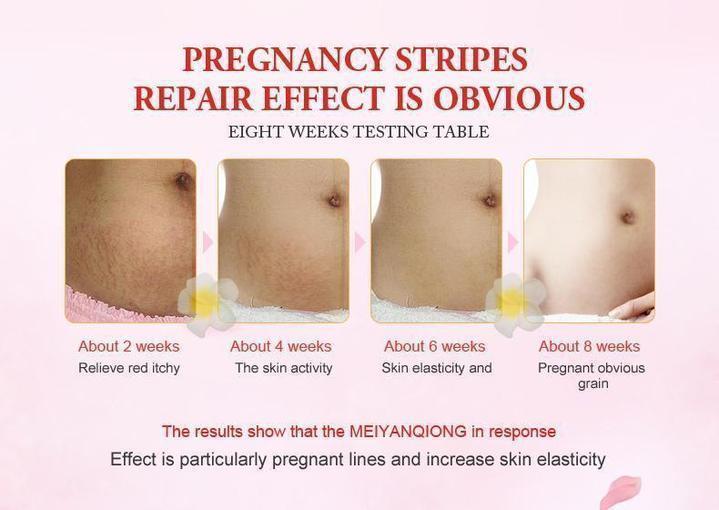 Anti Stretch Mark Cream - RAPBLUE