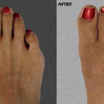 Elastic Bunion Corrector 2.0 - RAPBLUE