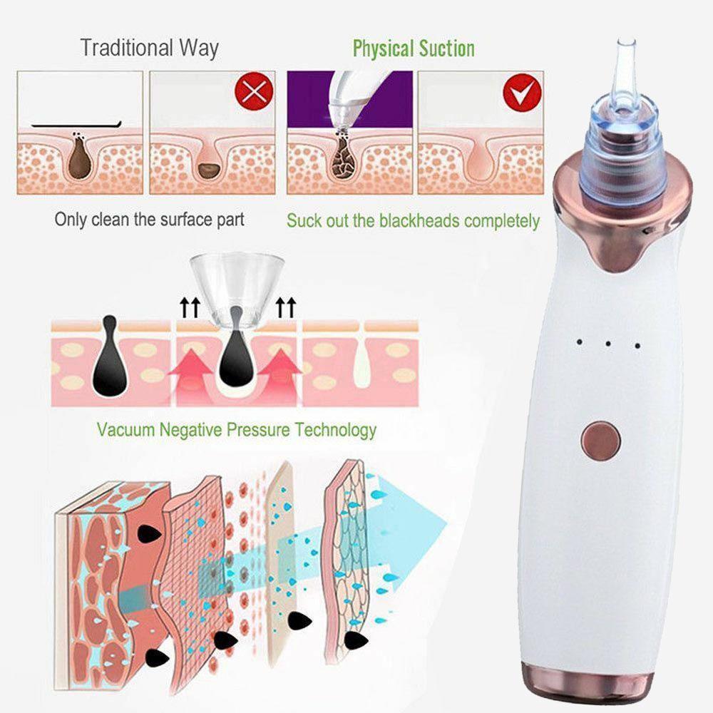 Blackhead Remover Vacuum - Pimple & Acne Suction Tool - RAPBLUE