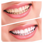 Teeth Whitening kit - RAPBLUE