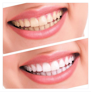 Teeth Whitening kit - RAPBLUE