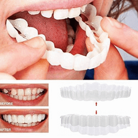 PERFECT SMILE SNAP ON BRACES - RAPBLUE