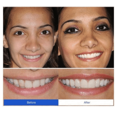 PERFECT SMILE SNAP ON BRACES - RAPBLUE