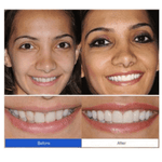 PERFECT SMILE SNAP ON BRACES - RAPBLUE