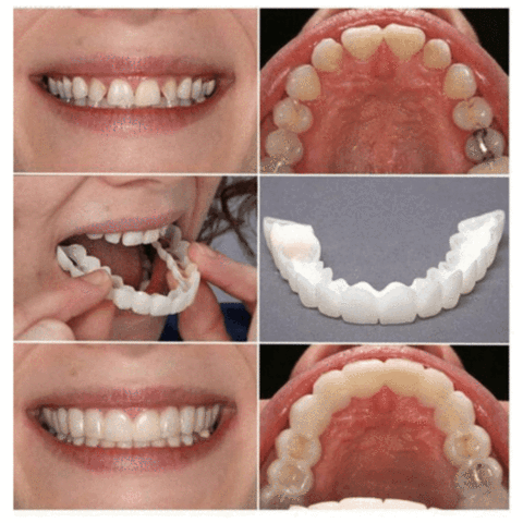 PERFECT SMILE SNAP ON BRACES - RAPBLUE