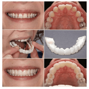 PERFECT SMILE SNAP ON BRACES - RAPBLUE