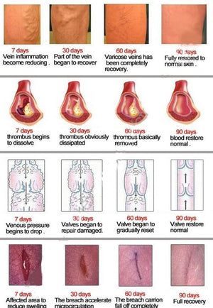 Varicose Veins Treatment Cream - RAPBLUE