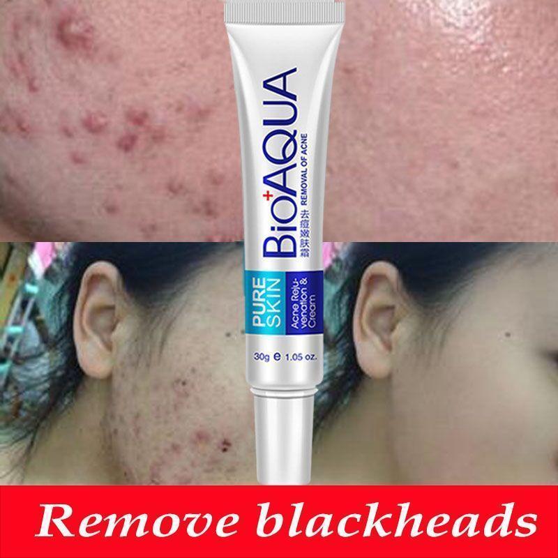 Anti Blackhead Removal Acne Cream - RAPBLUE