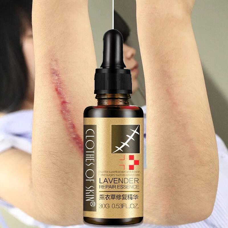 Essential Massage oils Scar Removal - RAPBLUE